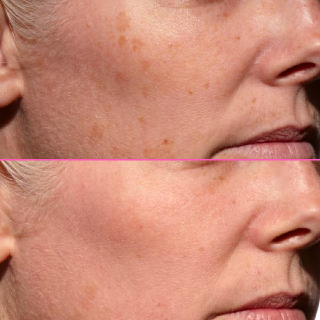 Before and after comparison of a person's face with visible skin texture changes.